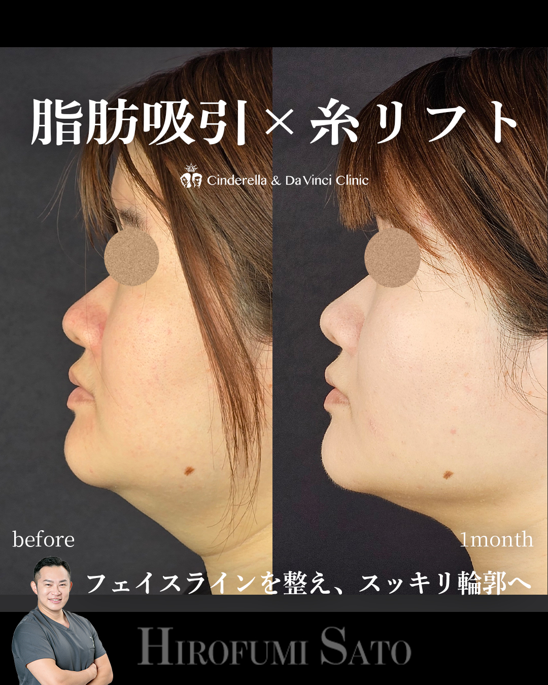 スッキリとした輪郭へ