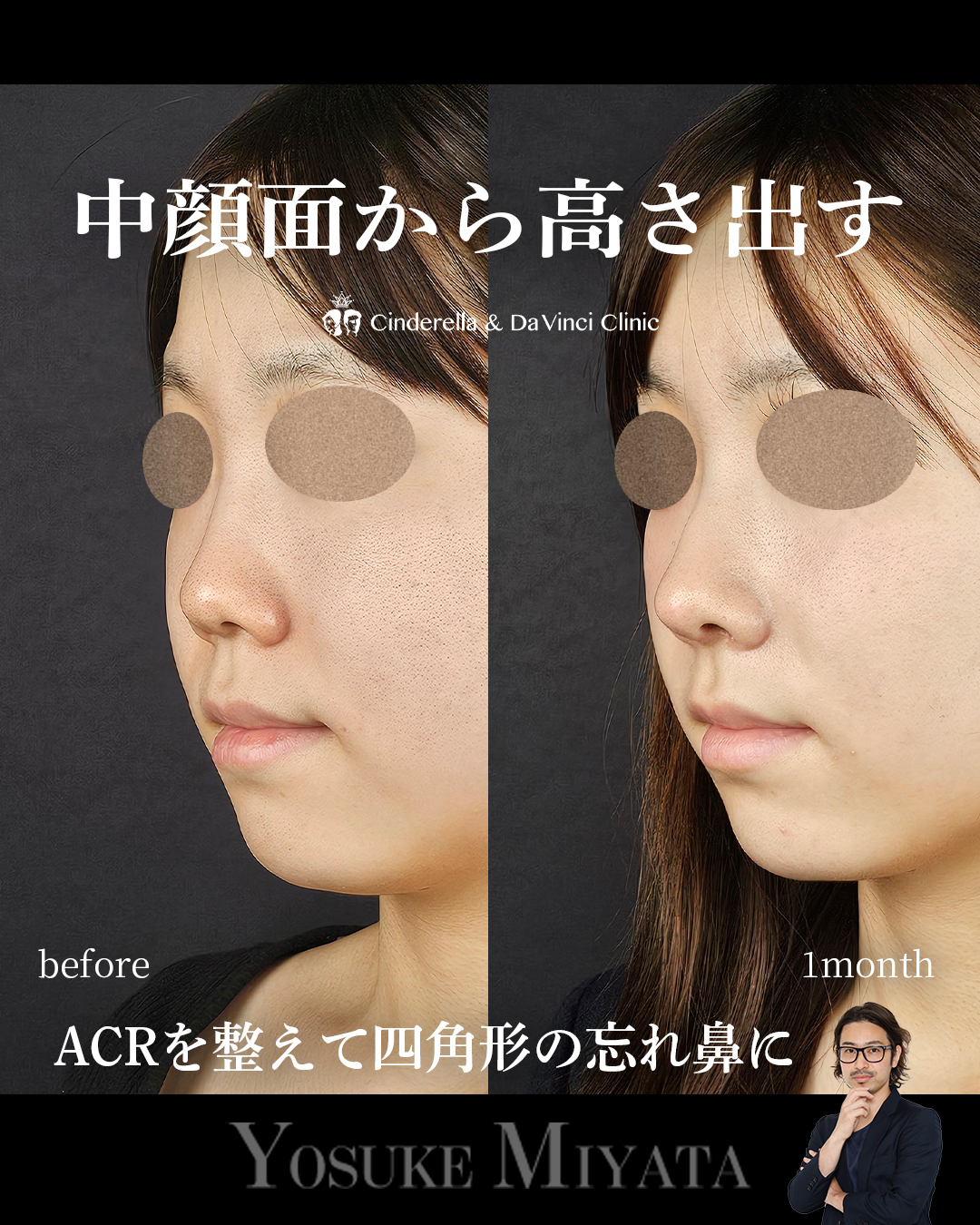 中顔面から高さを出す