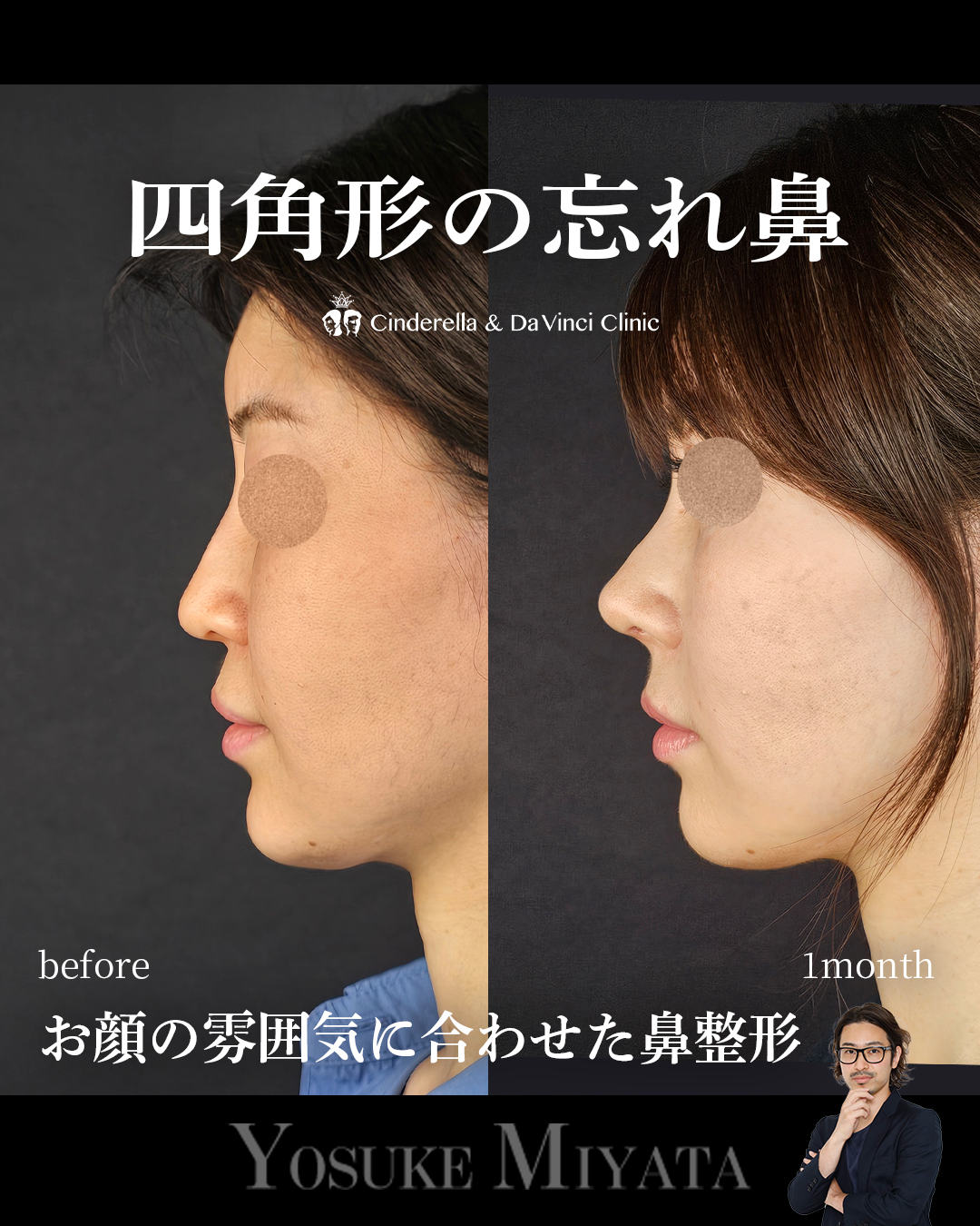 お顔の雰囲気に合わせた鼻整形