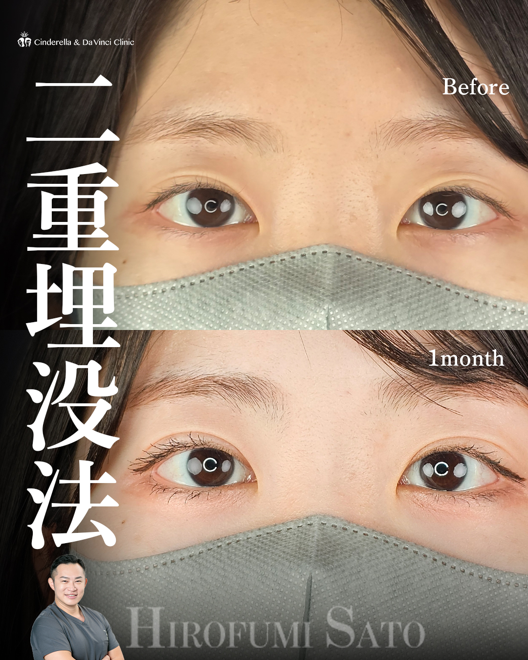他院埋没の留めなおし