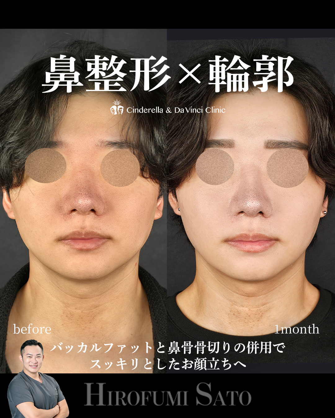 スッキリとした顔立ちへ