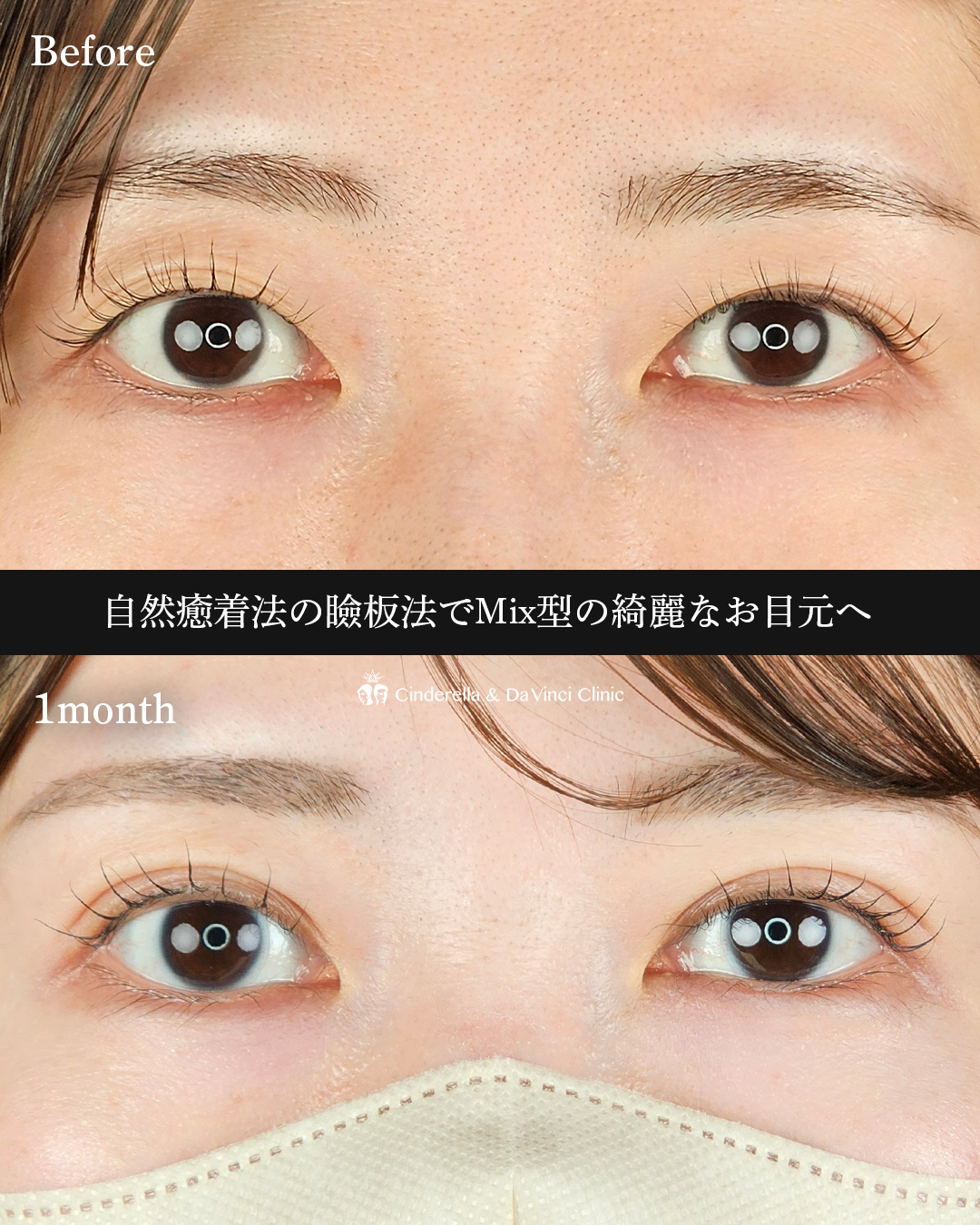 Mix型の綺麗な二重の画像