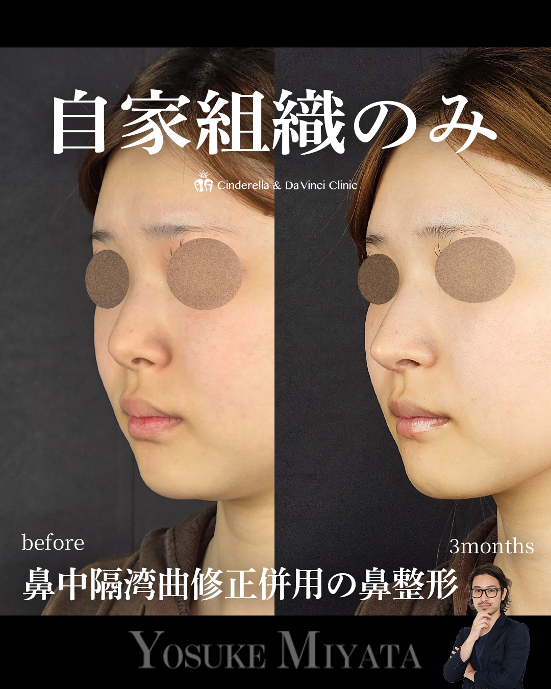 自家組織のみで鼻整形の画像