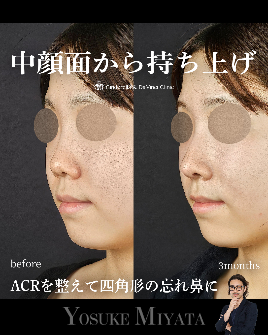 中顔面から高さを出すの画像
