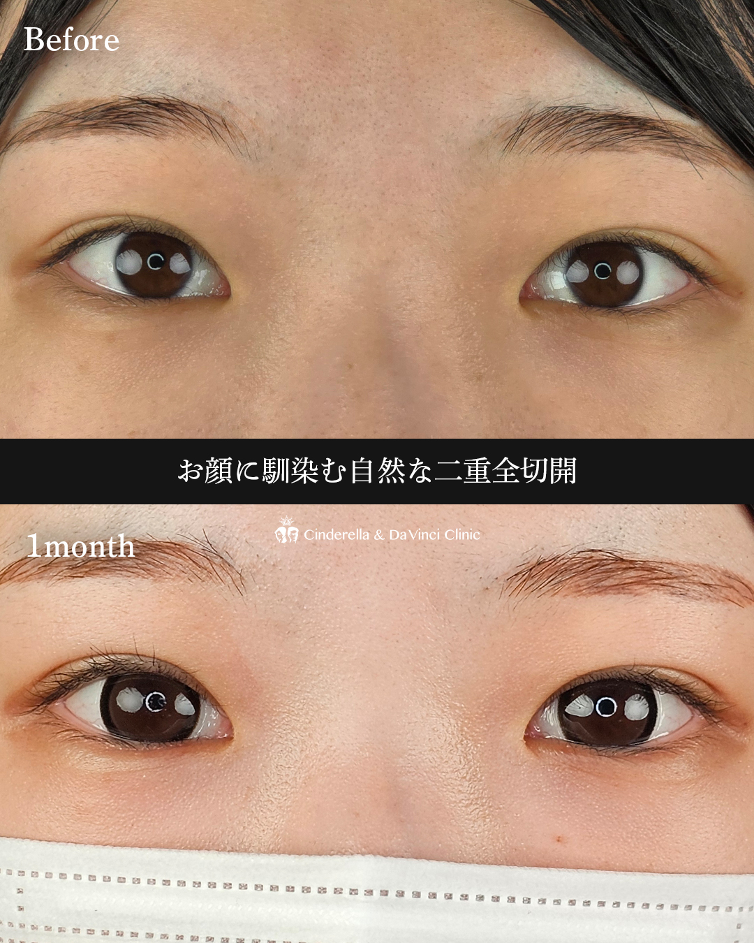自然な二重切開の画像
