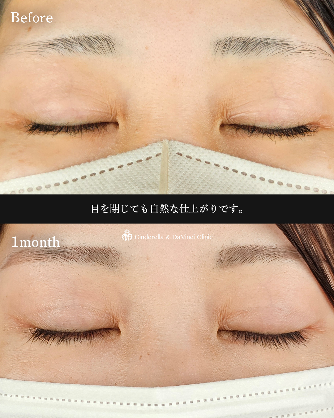 ぱっちり二重の画像
