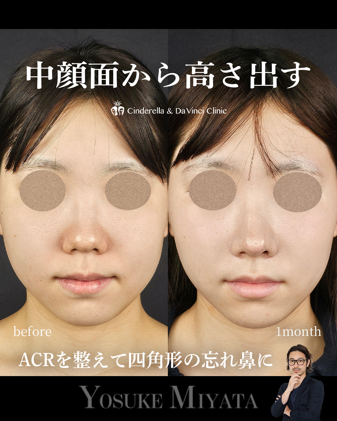 中顔面から高さを出すの画像