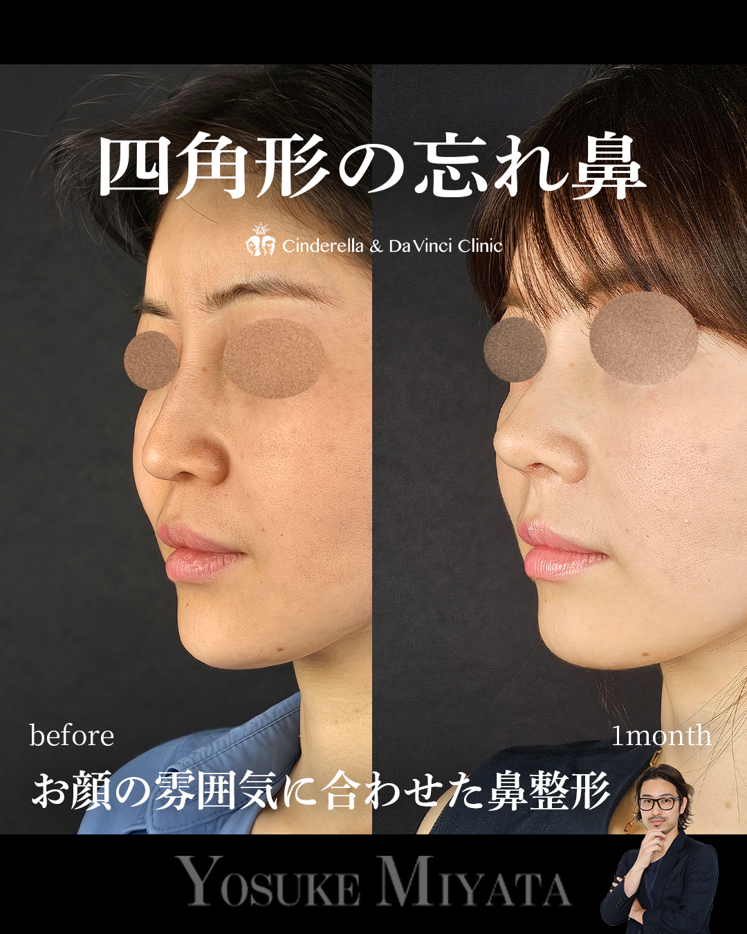 お顔の雰囲気に合わせた鼻整形の画像