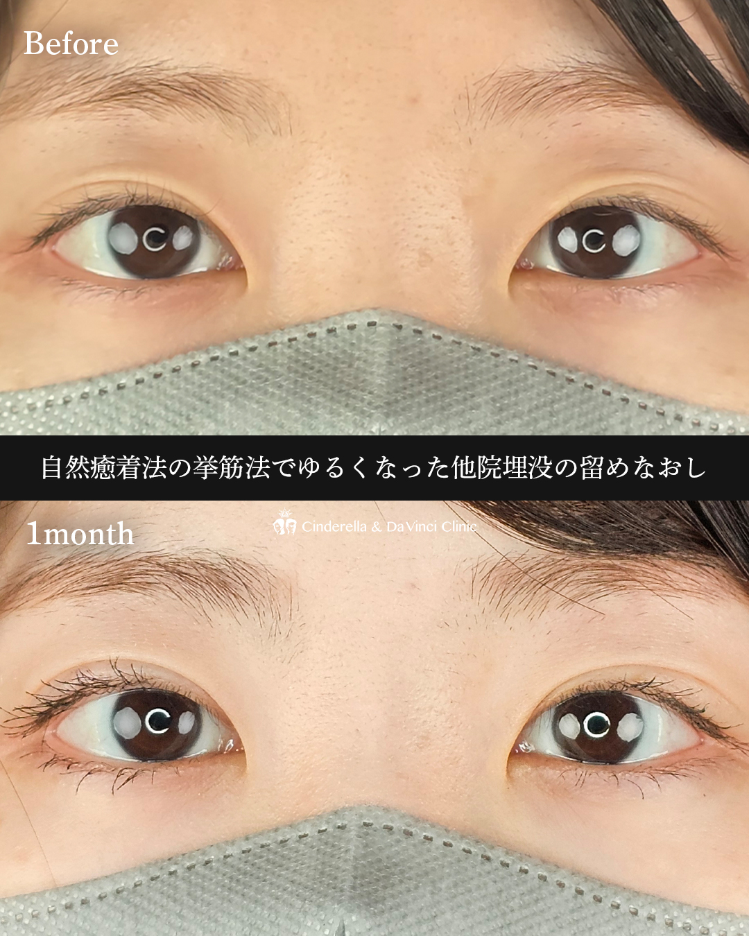 他院埋没の留めなおしの画像