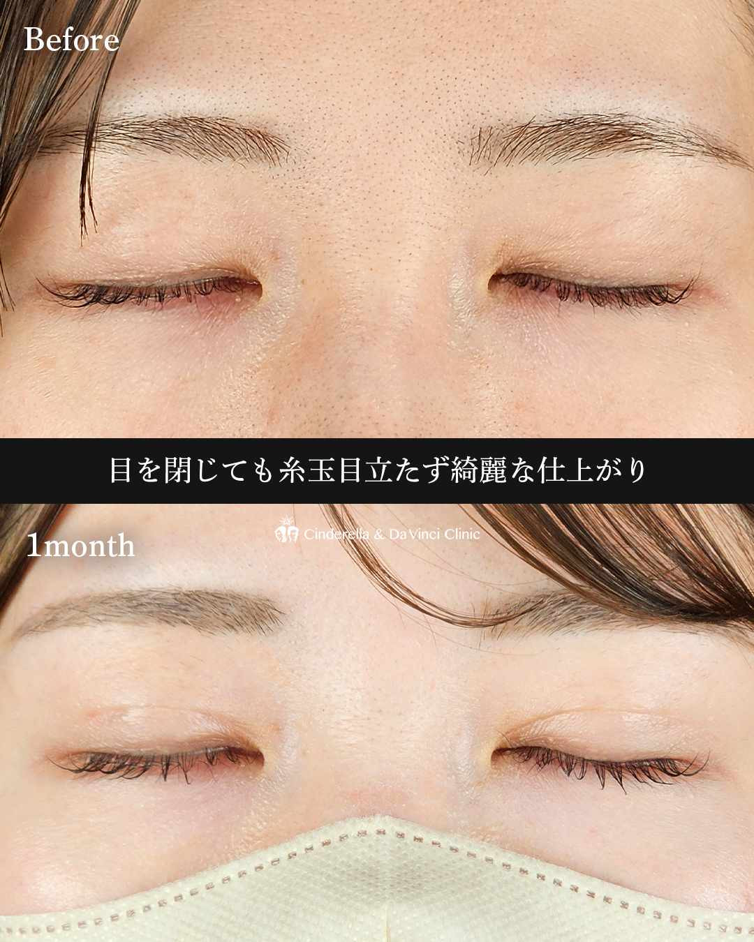 Mix型の綺麗な二重の画像