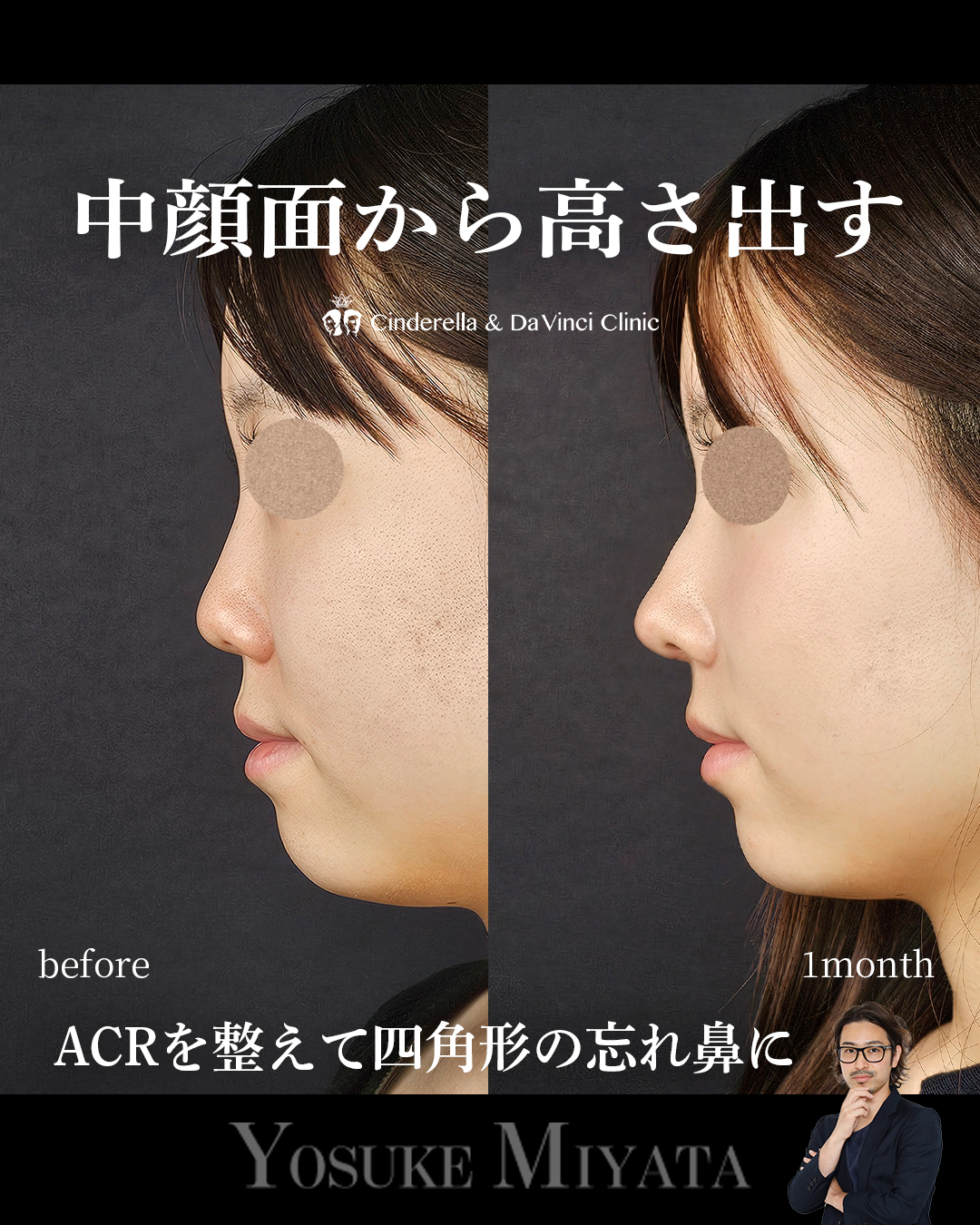 中顔面から高さを出すの画像