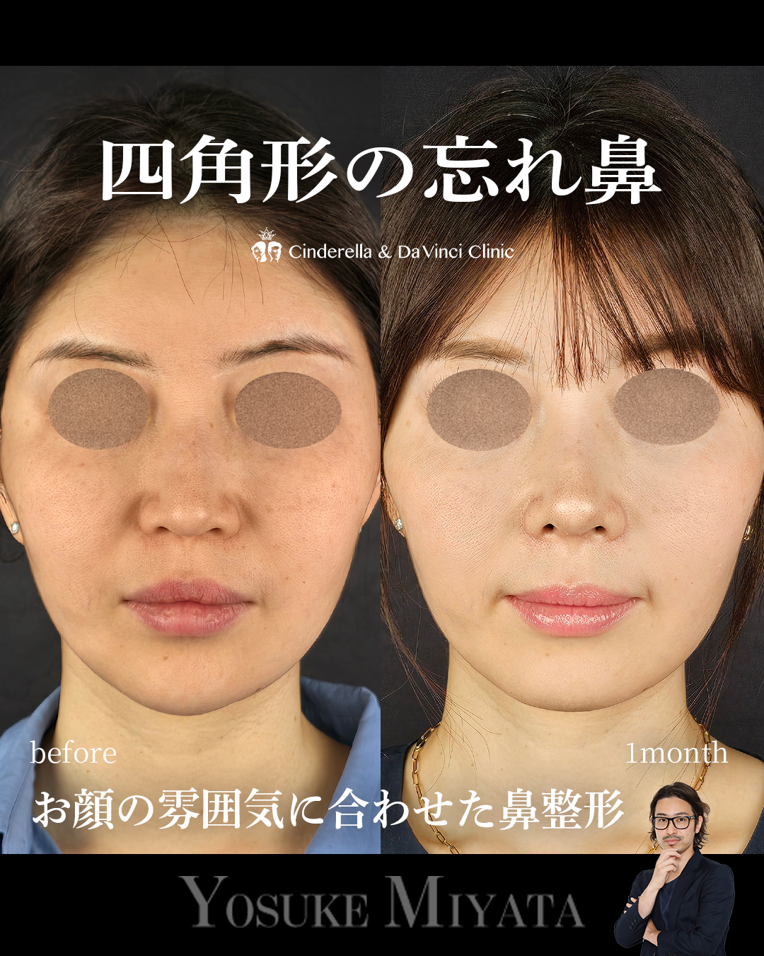 お顔の雰囲気に合わせた鼻整形の画像