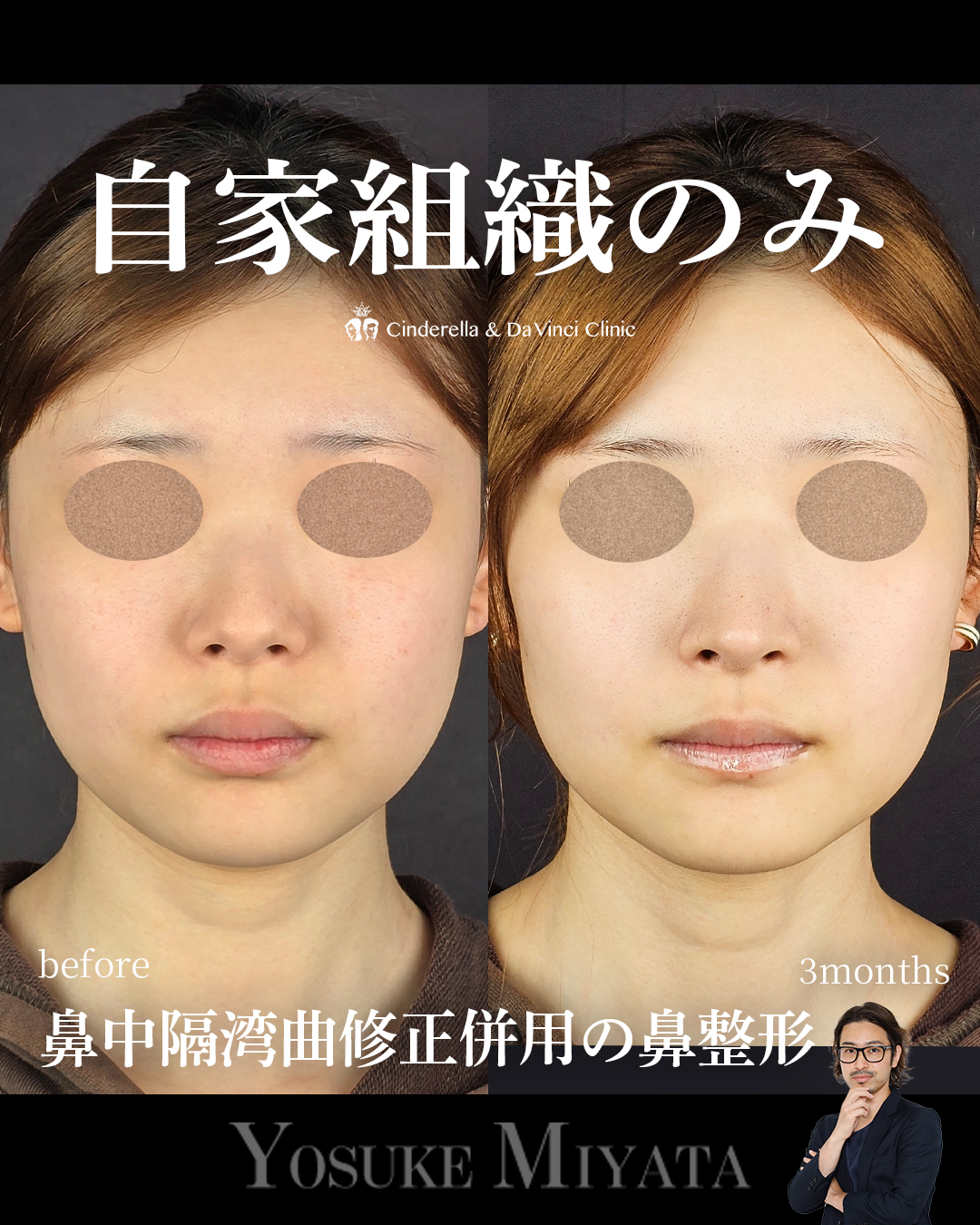 自家組織のみで鼻整形の画像