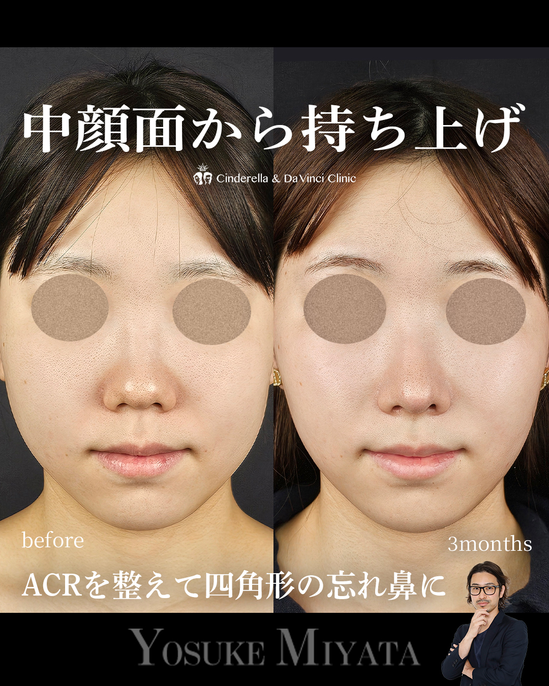 中顔面から高さを出すの画像