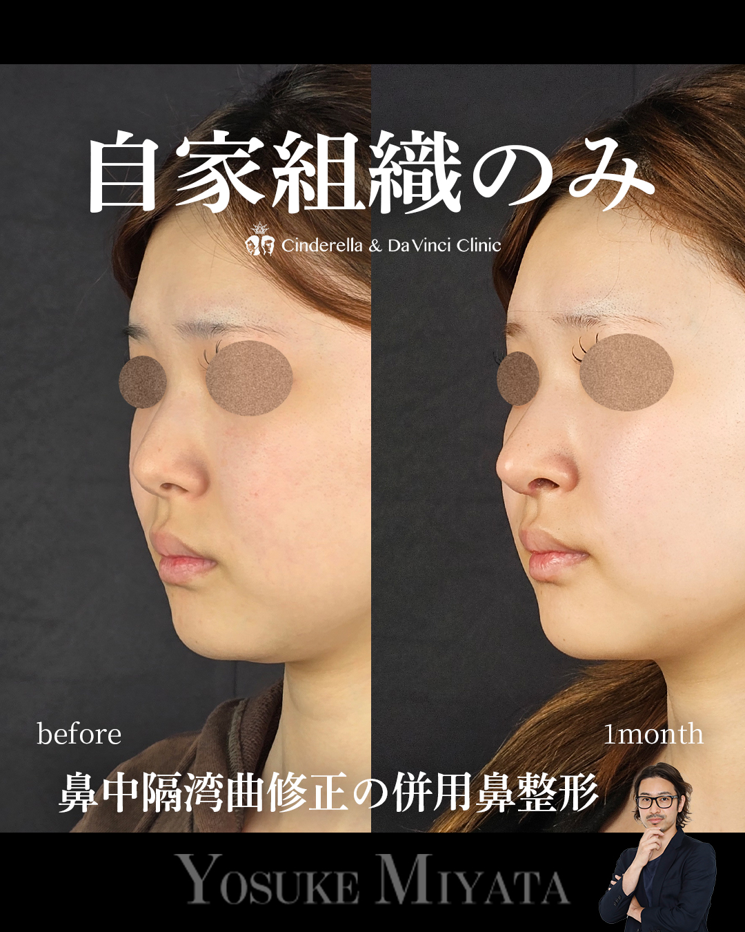 自家組織のみで鼻整形の画像