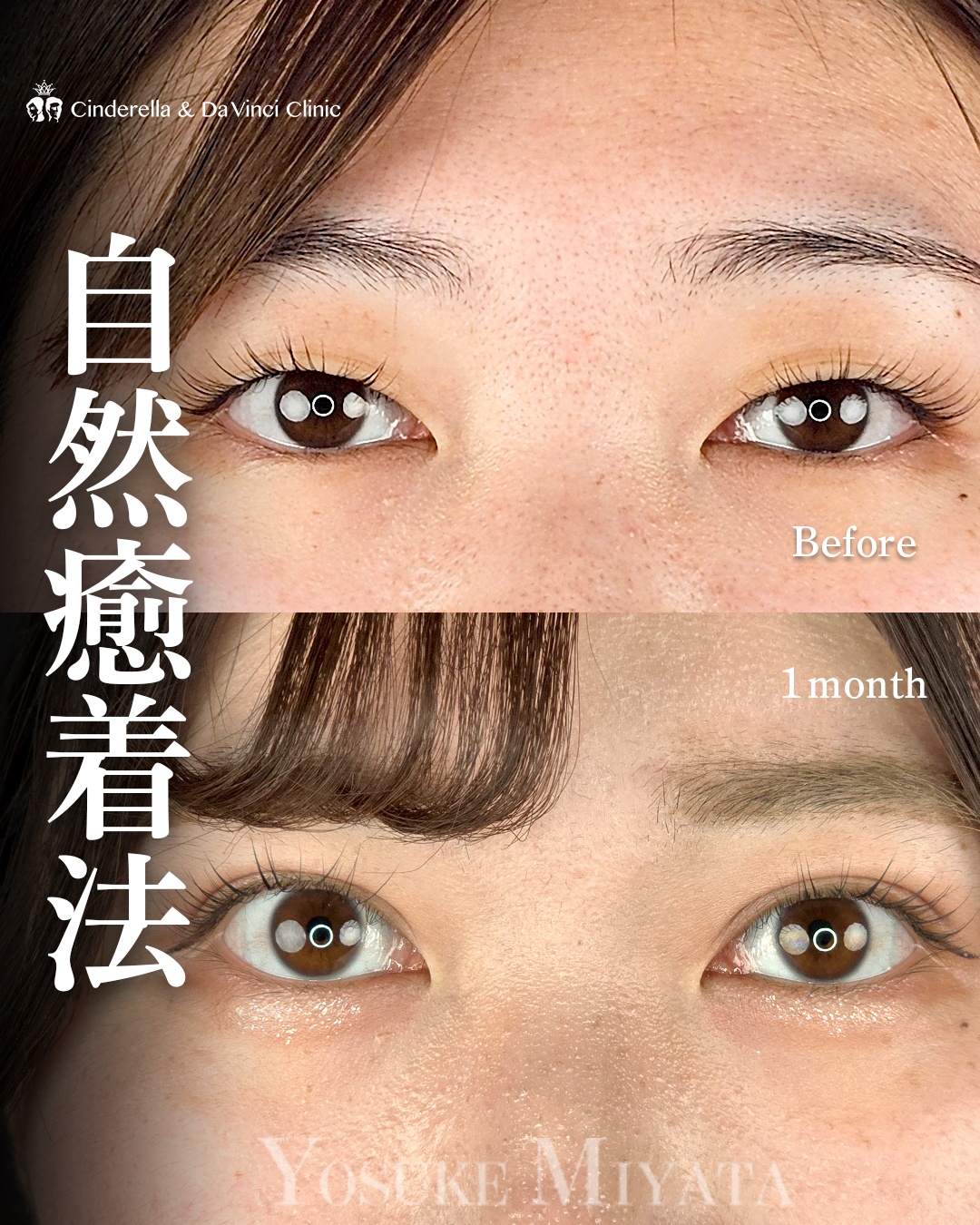 一重から平行二重