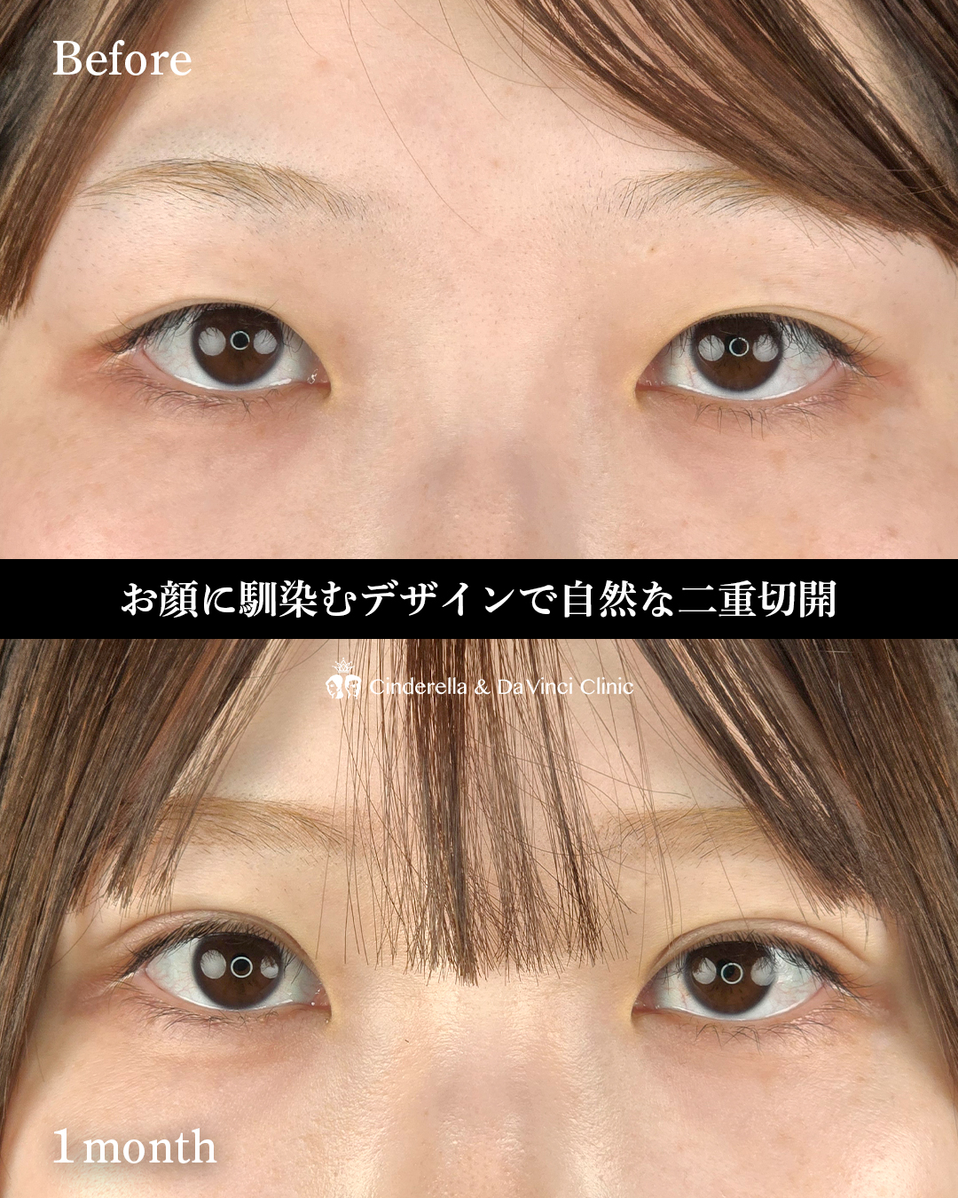 二重切開でミックス型の画像