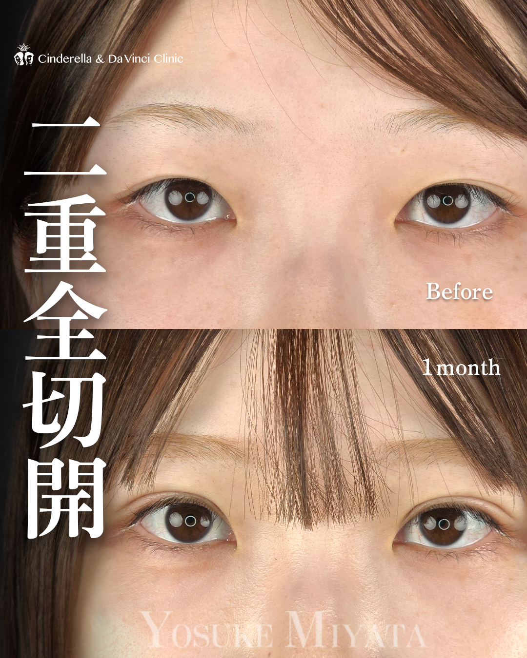 二重切開でミックス型