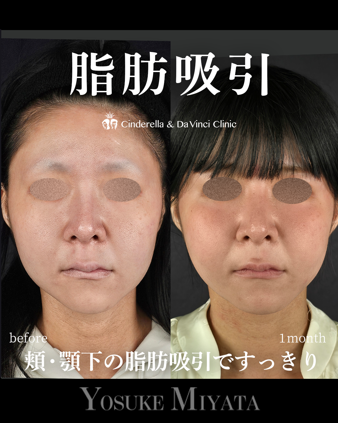 顔の脂肪吸引の画像
