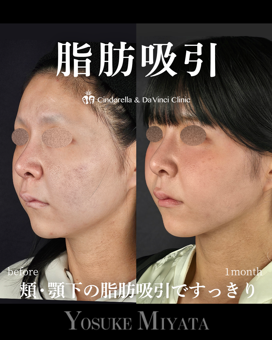 顔の脂肪吸引の画像