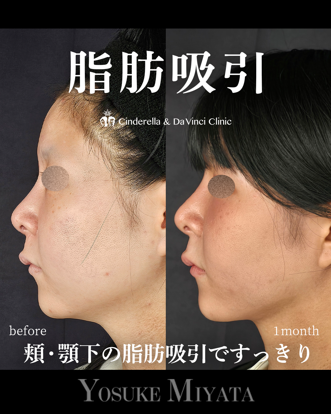 顔の脂肪吸引