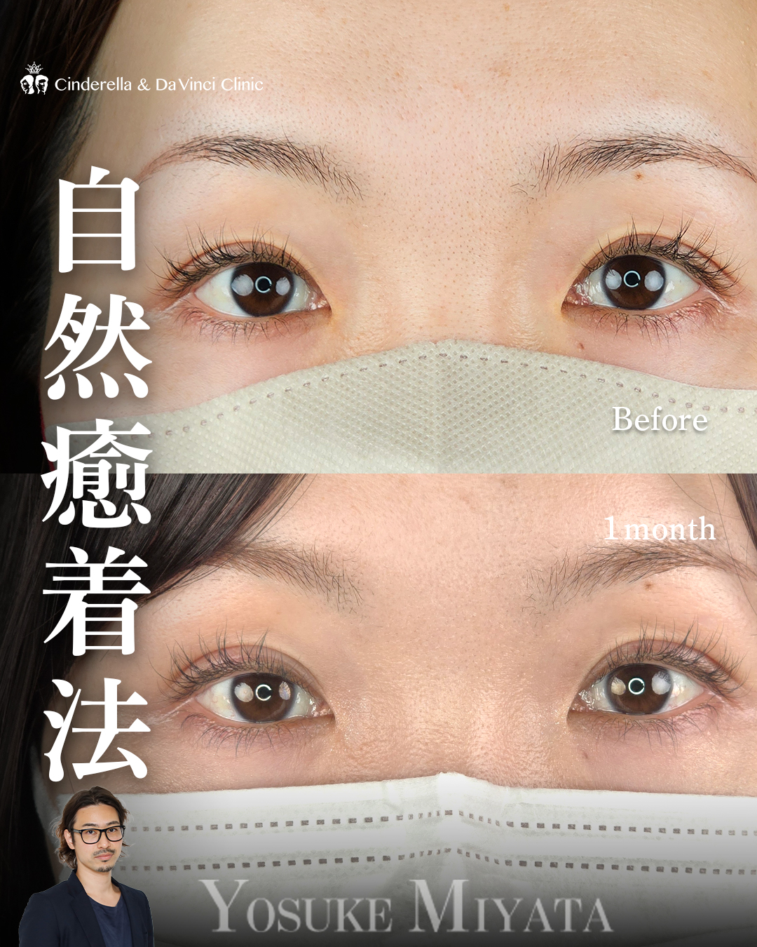 取れにくい自然癒着法