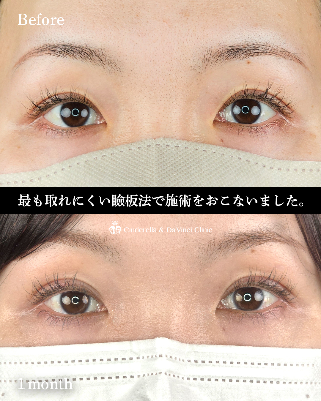 取れにくい自然癒着法の画像