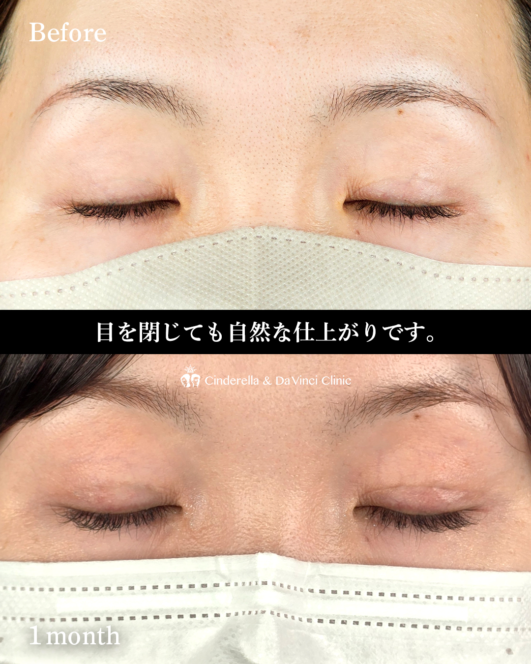 取れにくい自然癒着法の画像