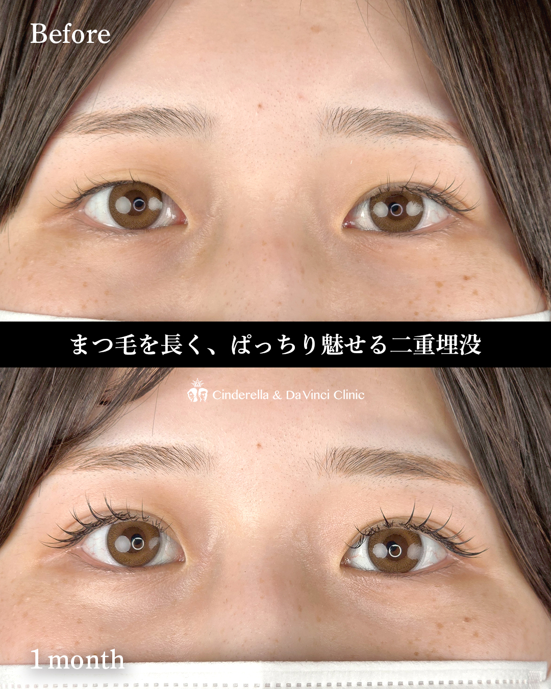 2点留め埋没修正の画像