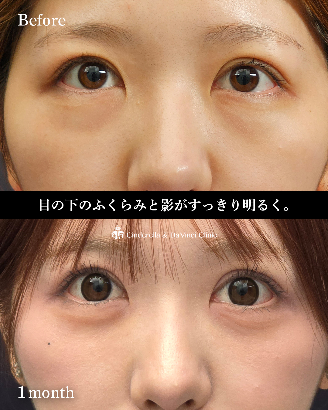 クマ取りで涙袋復活の画像