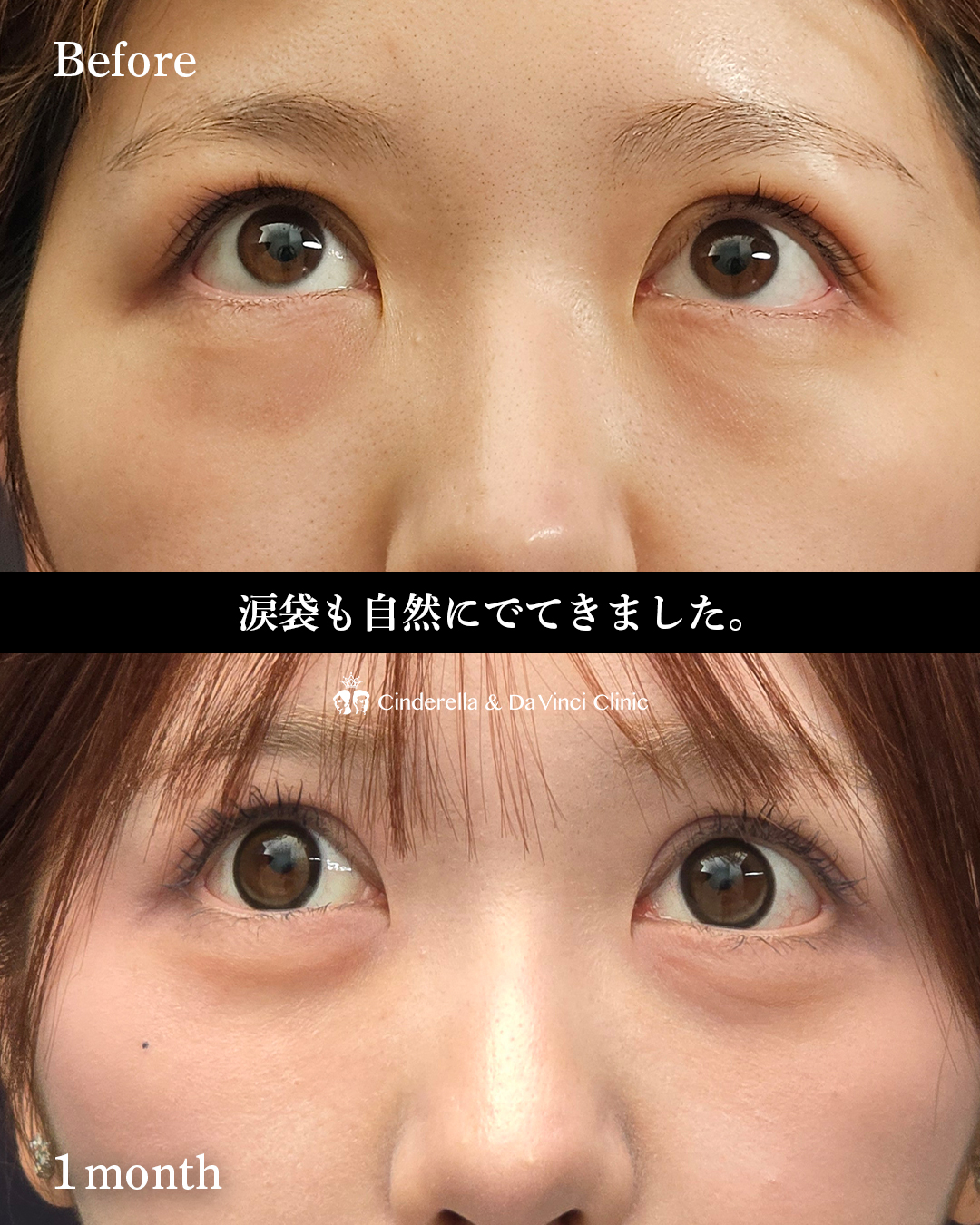 クマ取りで涙袋復活の画像