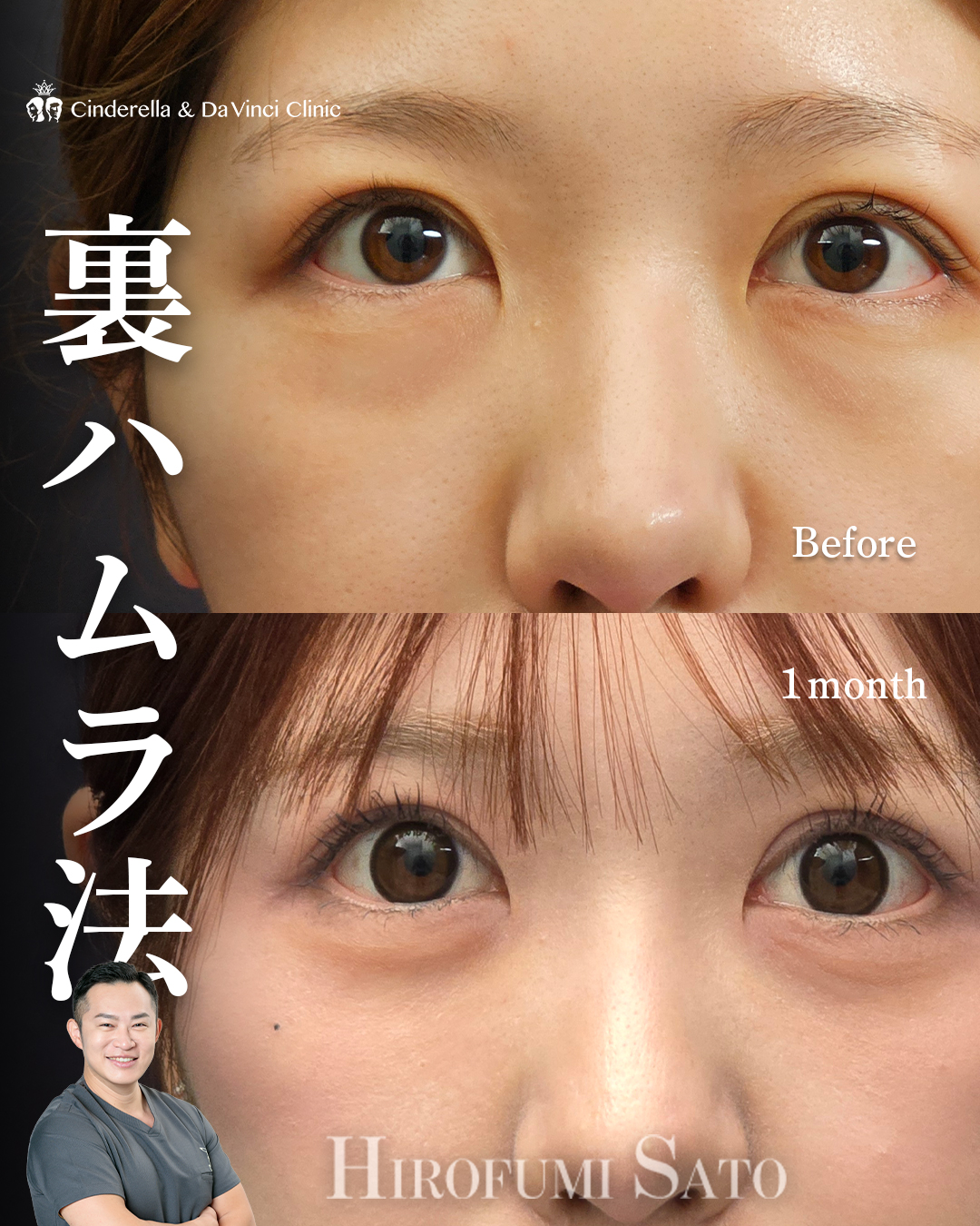 クマ取りで涙袋復活