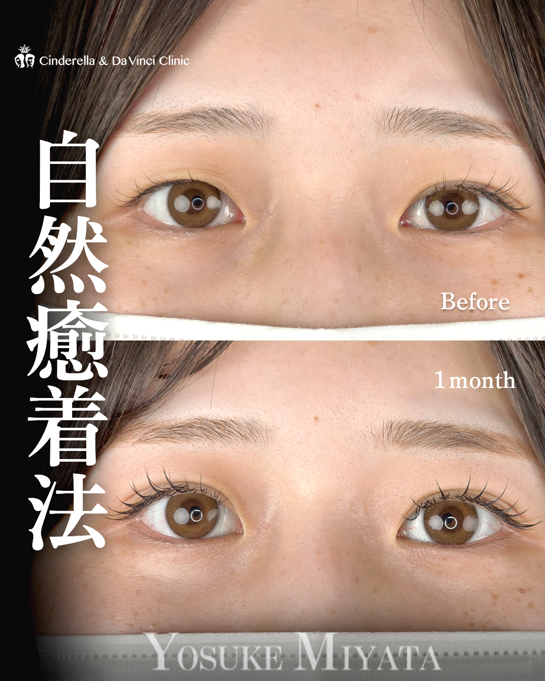 2点留め埋没修正