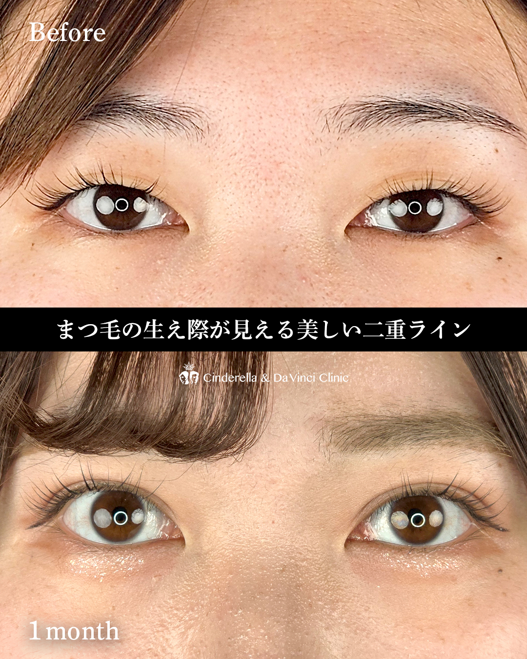 一重から平行二重の画像