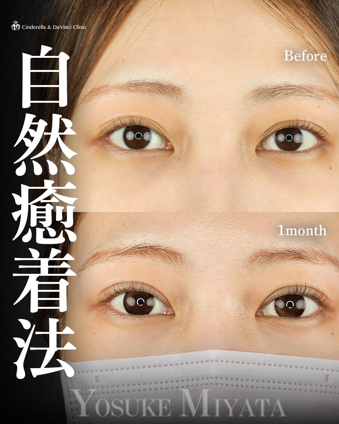 埋没で華やかな目元へ