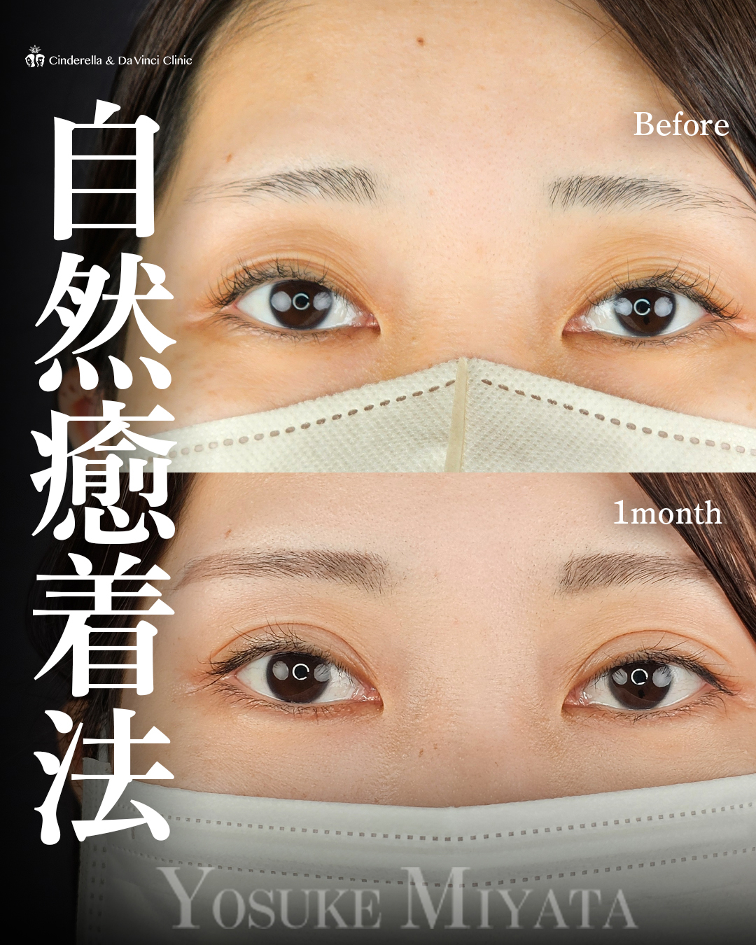ぱっちり二重