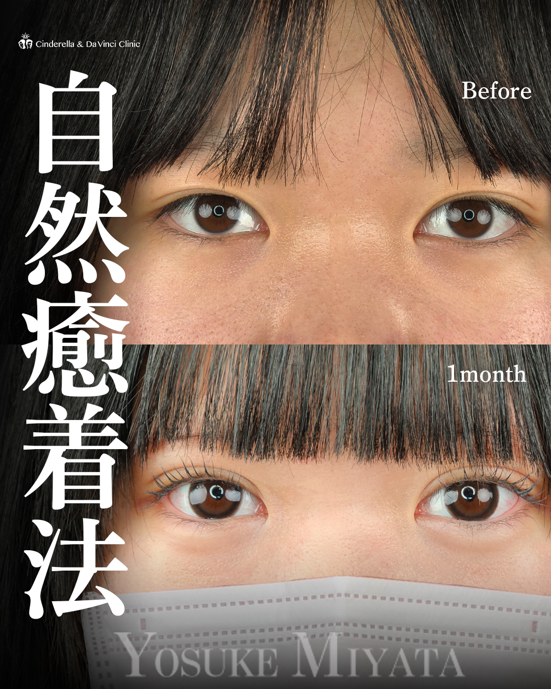 華やかで可愛い二重