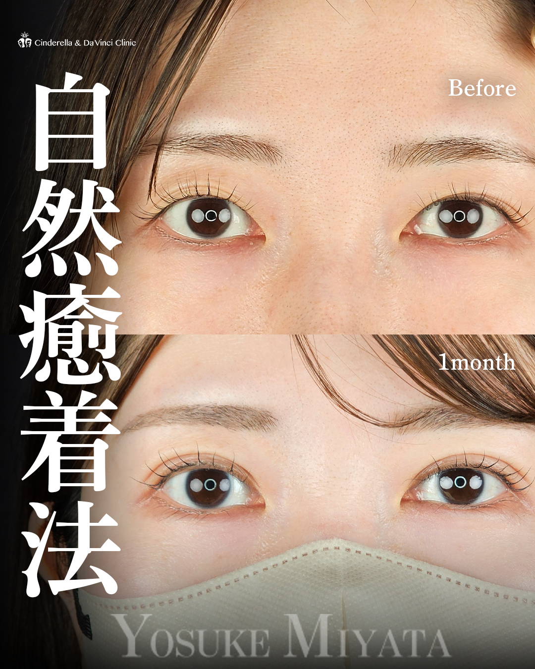 Mix型の綺麗な二重