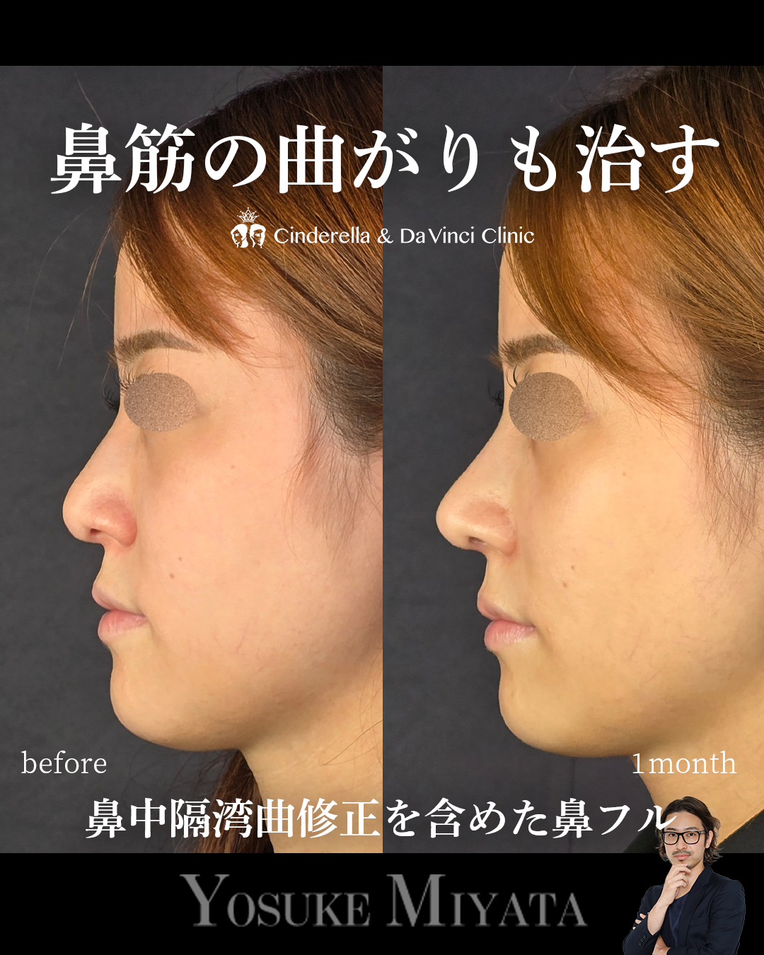 鼻中隔湾曲修正の画像