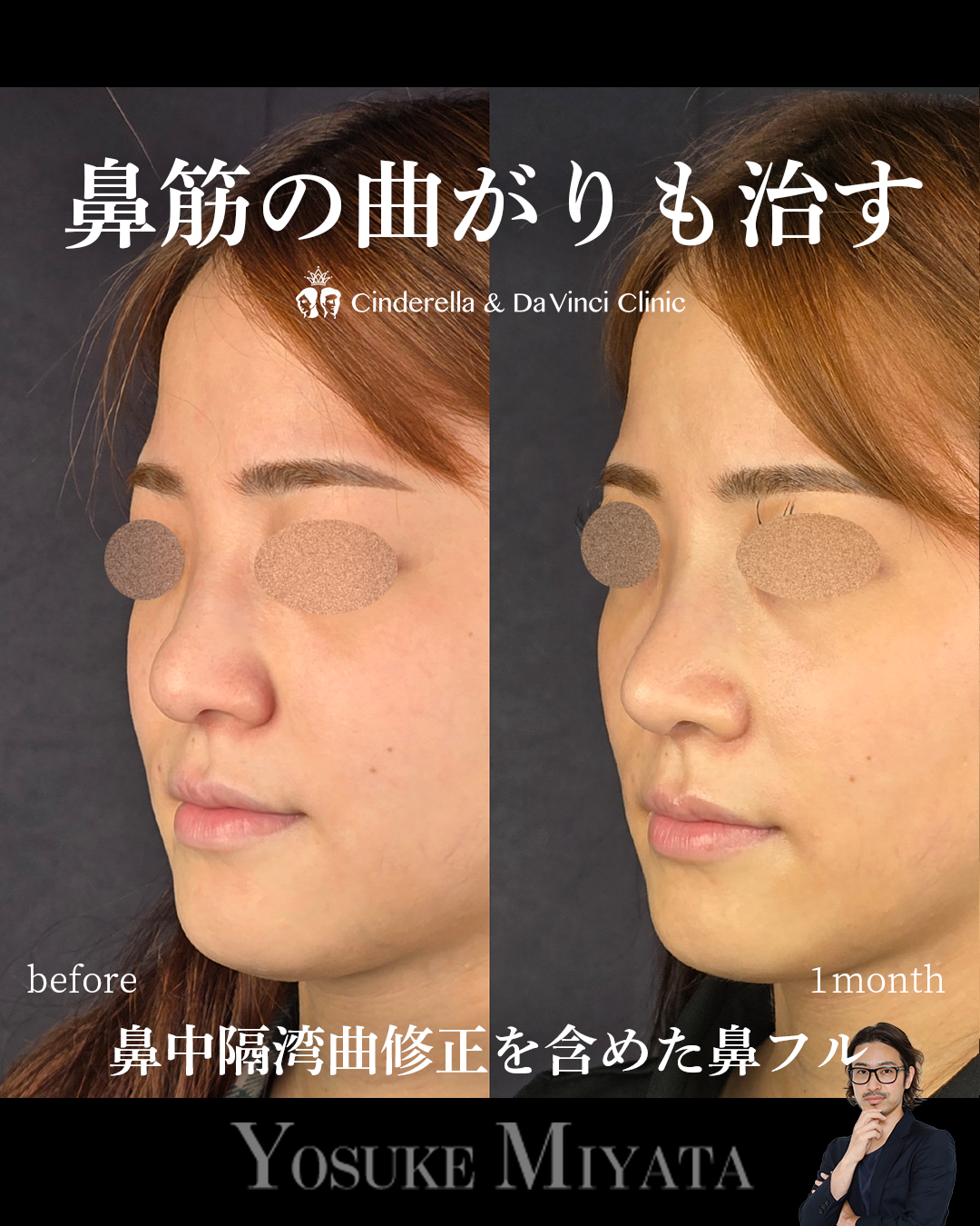 鼻中隔湾曲修正の画像