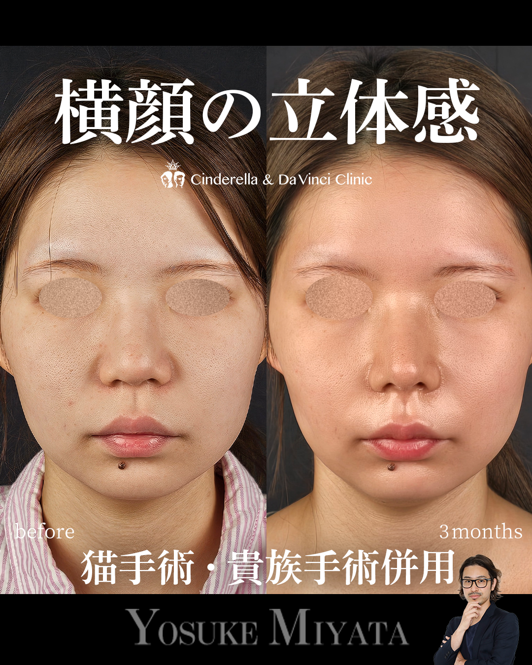 だんご鼻を自然に整えるの画像