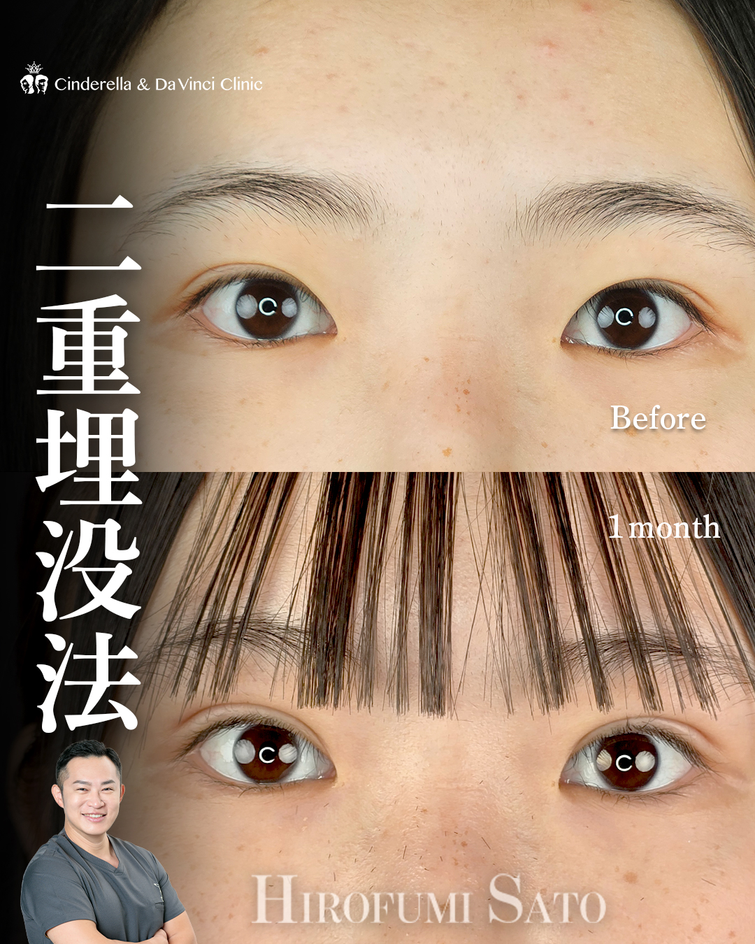 自然癒着法で二重幅を広げる