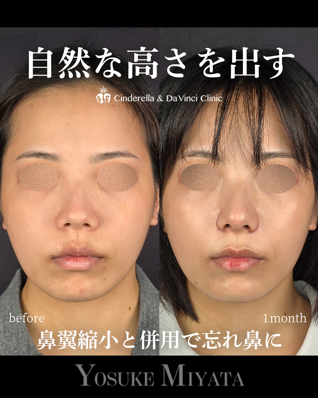 自然な高さを出す鼻整形の画像