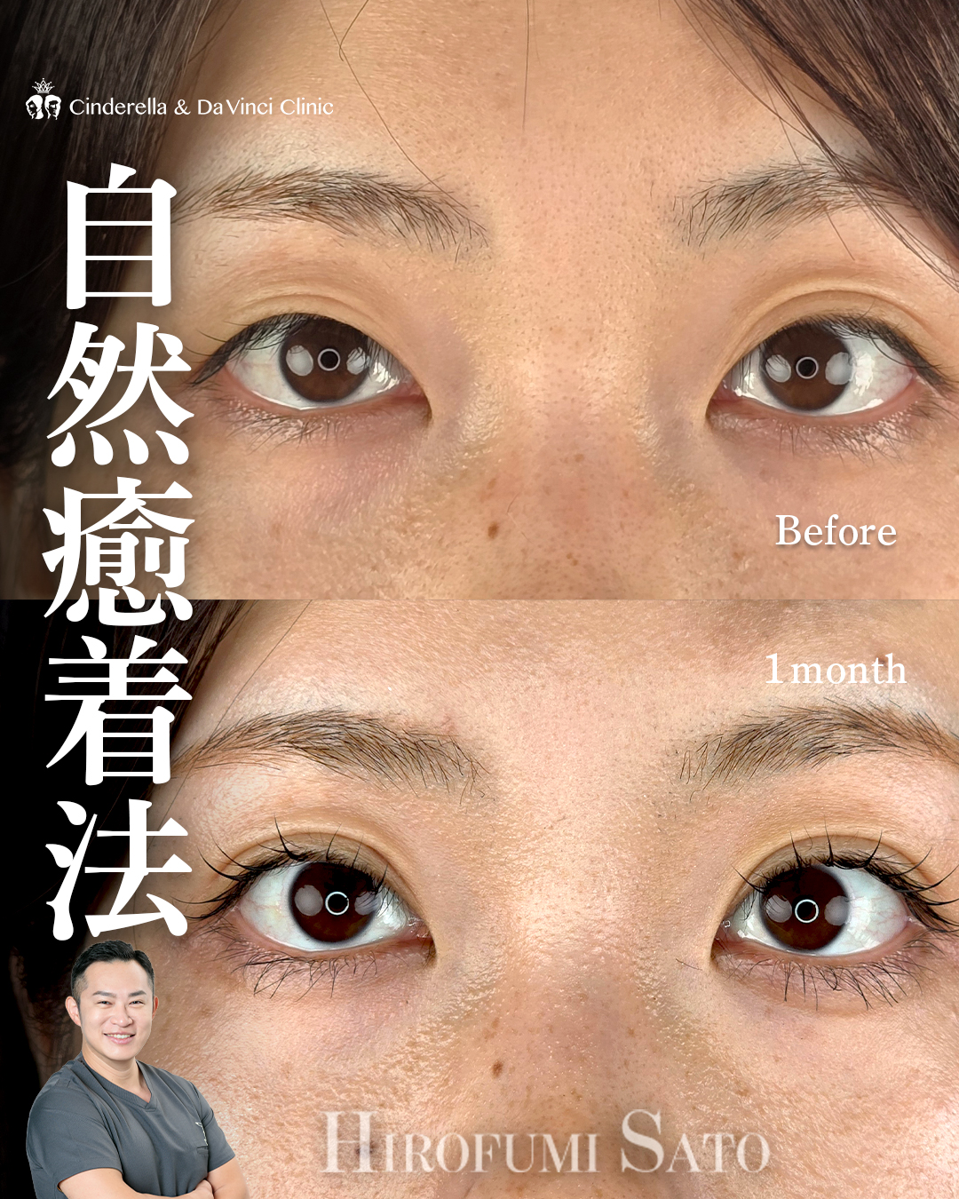 埋没で目を大きく