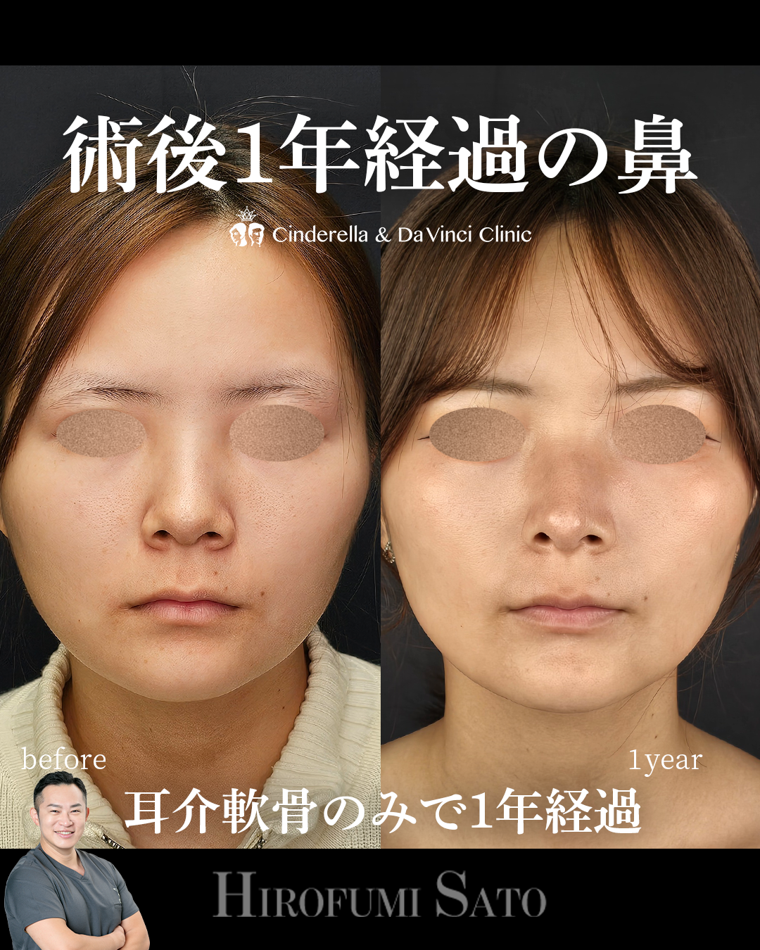 鼻整形で1年経過の画像