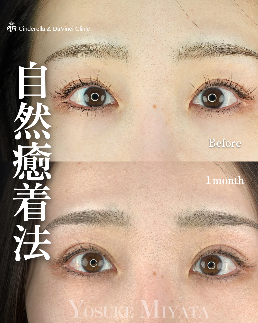自然癒着法で幅を広げる