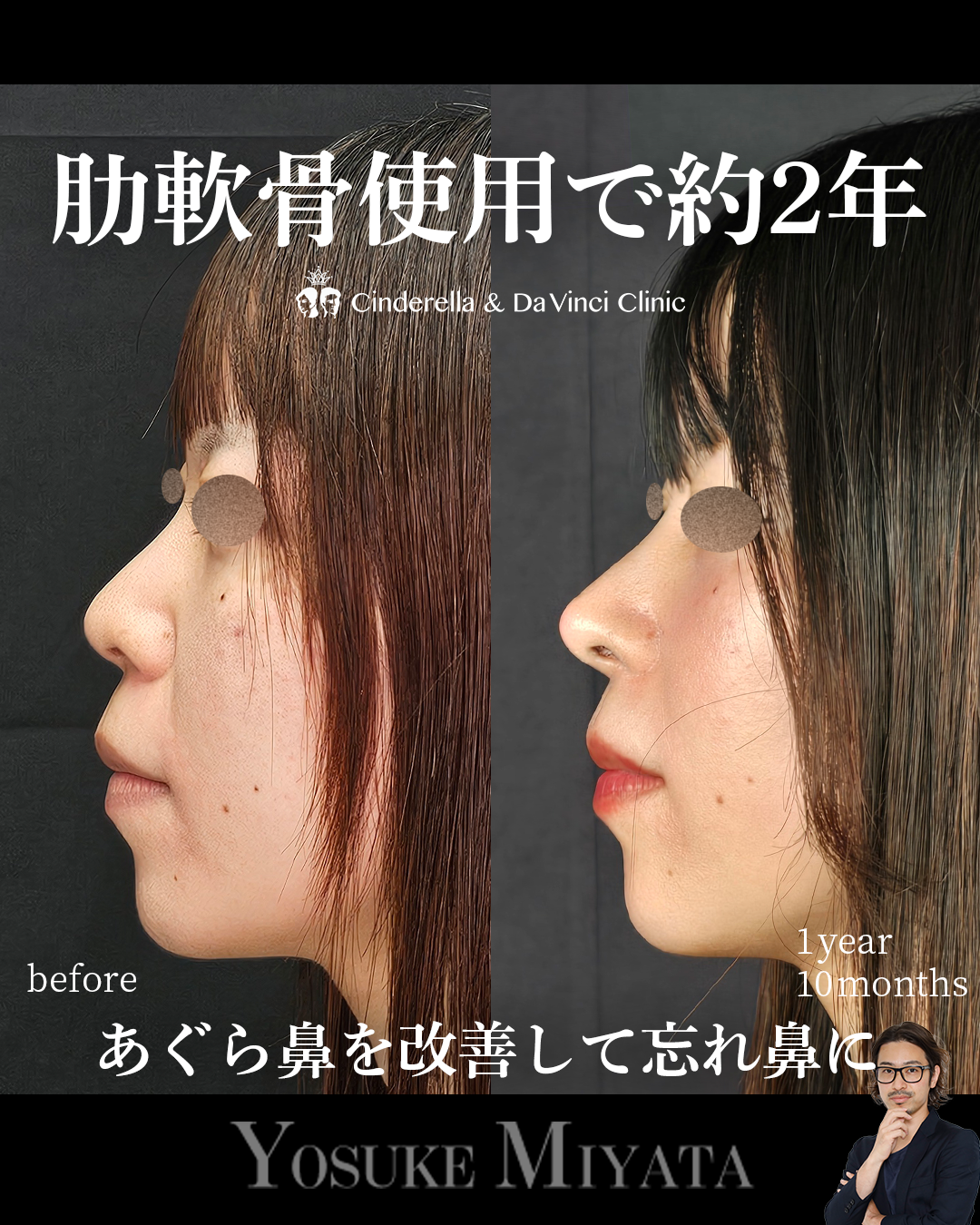 肋軟骨使用の鼻整形で2年経過