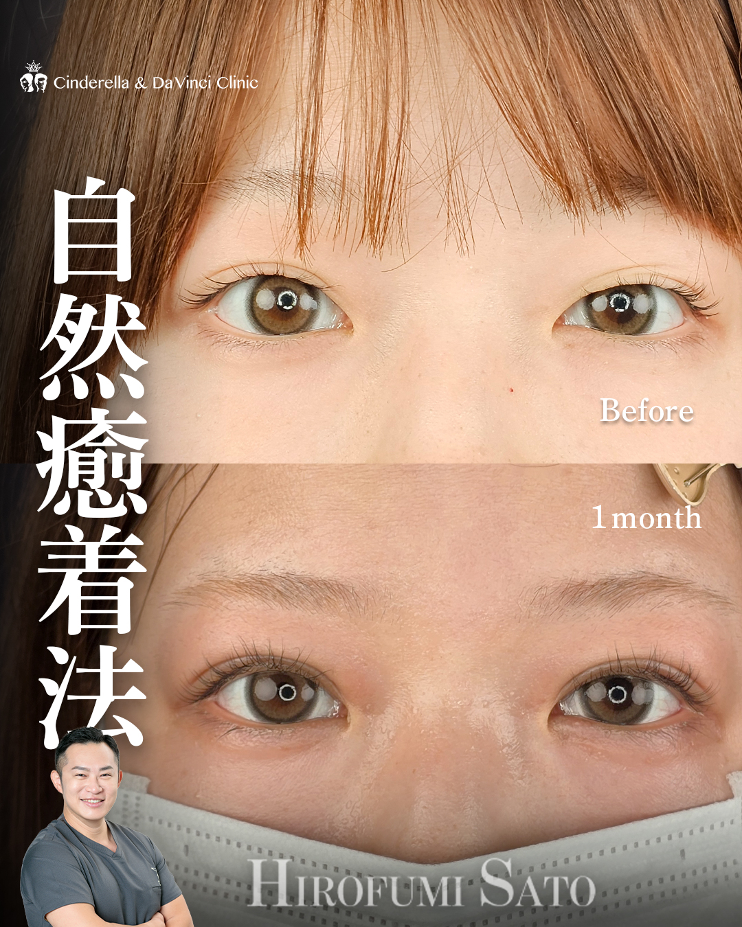 自然癒着の瞼板法