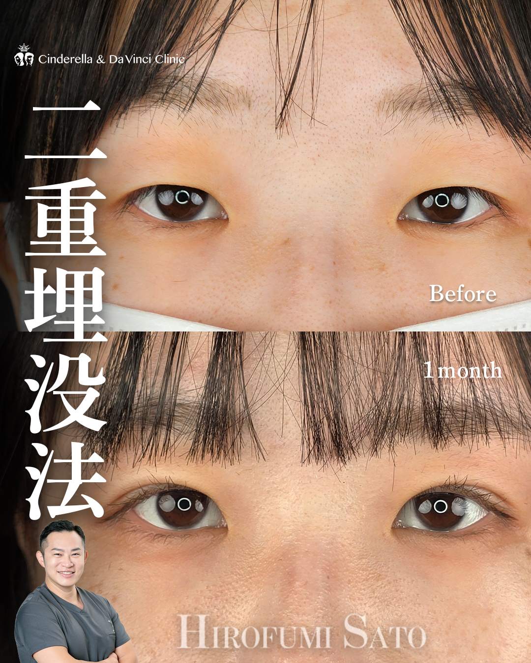 自然癒着法の末広二重