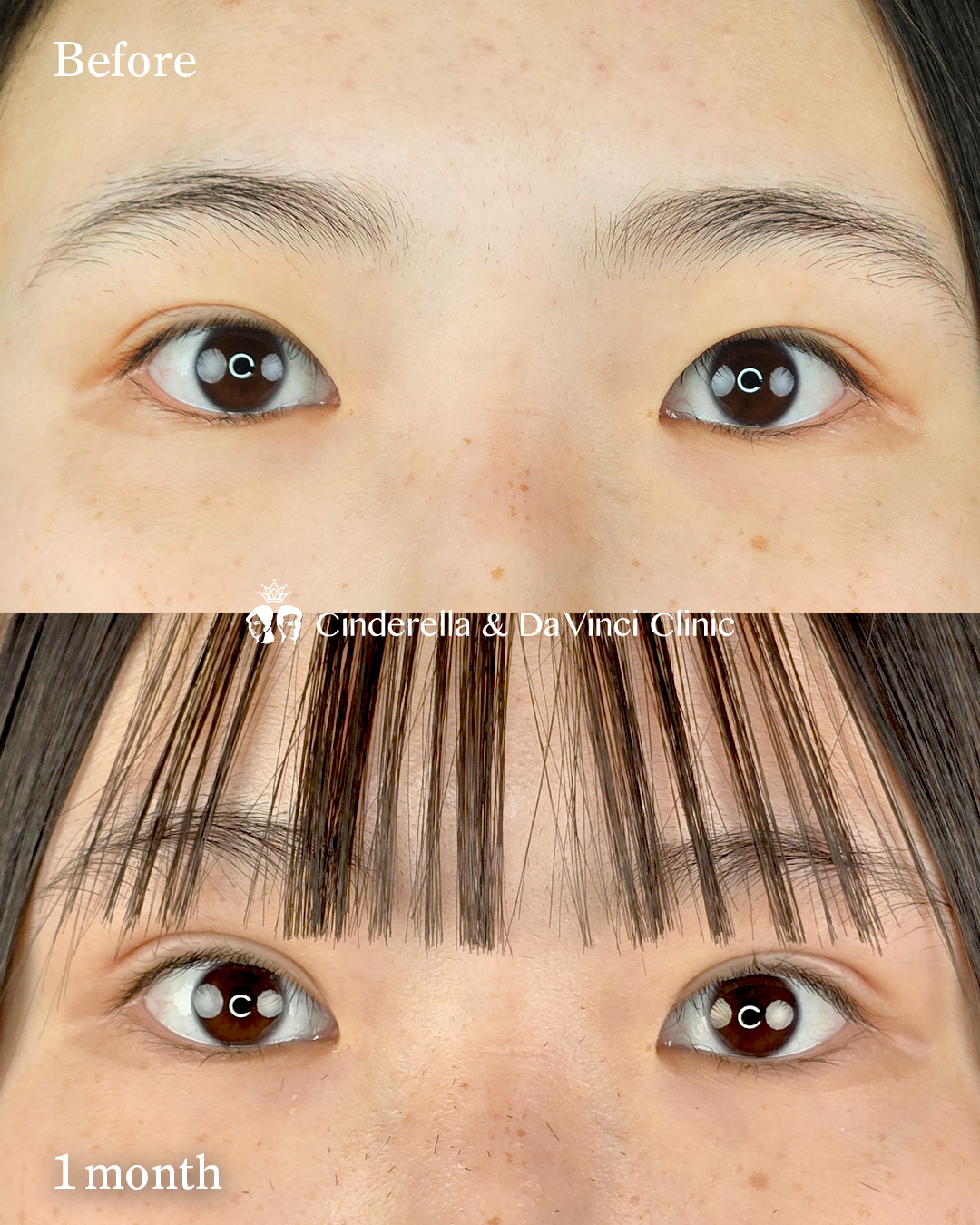 自然癒着法で二重幅を広げるの画像